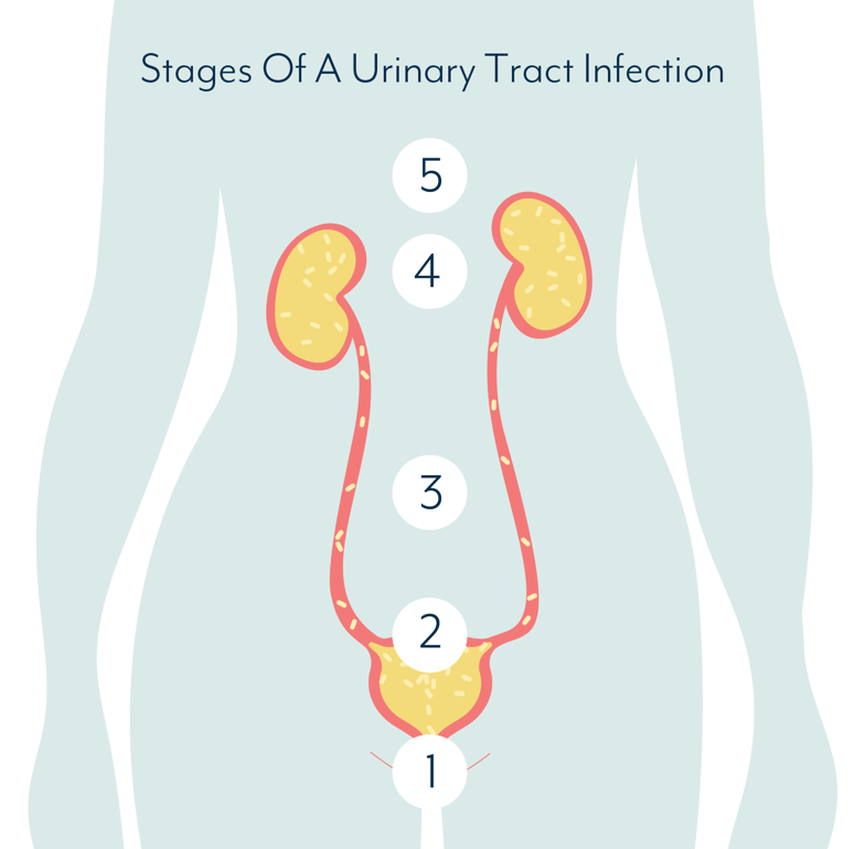 Stages Of A Urinary Tract Infection